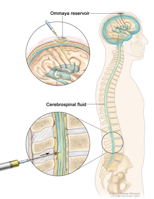 Medical illustration of a human spine connecting to brain with closeup of ommaya reservoir and cerebrospinal fluid