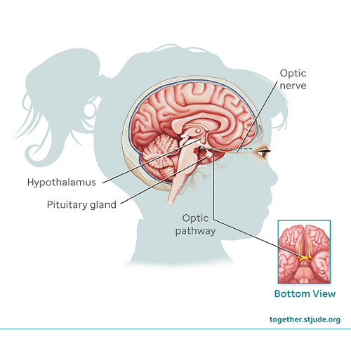 Optic pathway gliomas in children grow along structures of the visual system. 