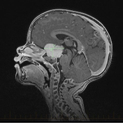 Les tumeurs des voies optiques chez les enfants se développent le long des structures du système visuel, y compris le nerf optique, les voies optiques et/ou le chiasma optique.