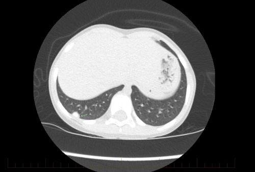 Una TC del tórax de un paciente joven con osteosarcoma muestra signos de la enfermedad metastásica.