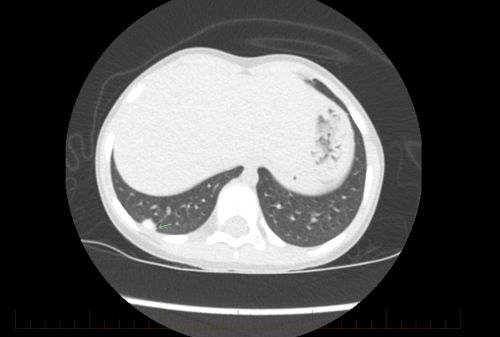 أشعة مقطعية على الصدر لطفل مريض بالساركوما العظمية تبين علامات المرض النقيلي