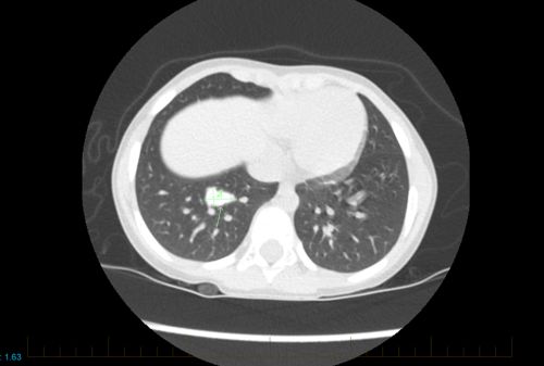 Obraz TK klatki piersiowej młodego pacjenta z kostniakomięsakiem wskazujący na obecność choroby przerzutowej