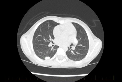Obraz TK klatki piersiowej młodego pacjenta z kostniakomięsakiem wskazujący na obecność choroby przerzutowej