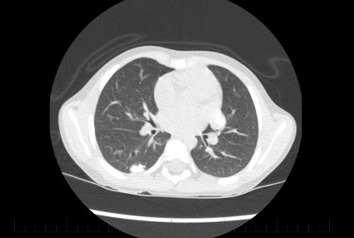 Una TC del tórax de un paciente joven con osteosarcoma muestra signos de la enfermedad metastásica.