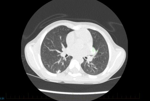 Una TC del tórax de un paciente joven con osteosarcoma muestra signos de la enfermedad metastásica.