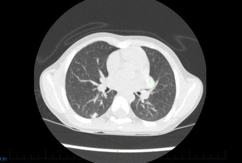 一名年轻骨肉瘤患者的胸部 CT 显示转移性疾病迹象