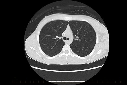 TC do tórax sem evidências de osteossarcoma metastático em um paciente pediátrico