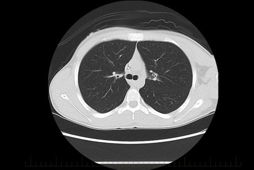 La tomodensitométrie claire du thorax ne montre aucun signe d'ostéosarcome métastatique chez un patient pédiatrique