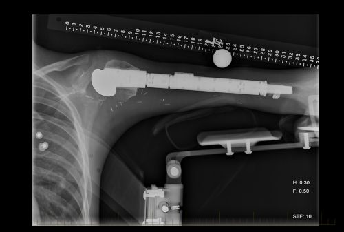 Obraz rentgenowski przedstawiający kość ramienną z protezą uzyskany po operacji oszczędzającej kończynę.