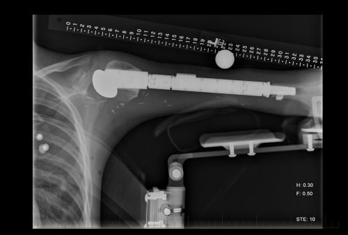 अंग को बचा कर ट्यूमर निकालने की सर्जरी के बाद कृत्रिम अंग को दर्शाता हुआ ह्यूमेरस का एक्स-रे।