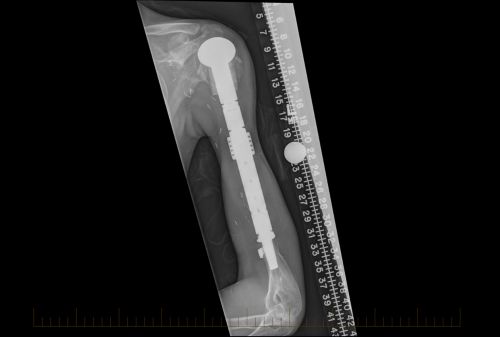 Obraz rentgenowski przedstawiający kość ramienną uzyskany po 3 latach od operacji oszczędzającej kończynę.