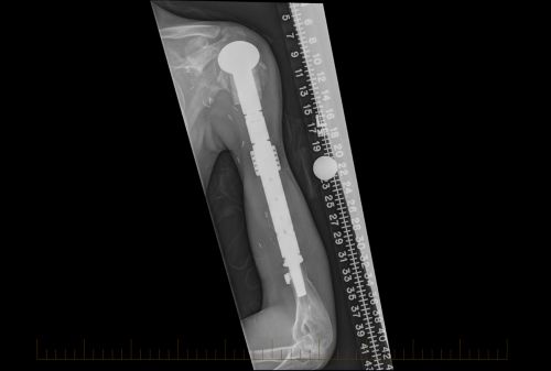 Radiografia do úmero 3 anos após cirurgia de preservação de membros.