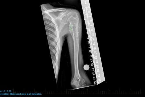 Przedoperacyjny obraz rentgenowski przedstawiający kość ramienną z oznaczonym i zmierzonym kostniakomięsakiem.