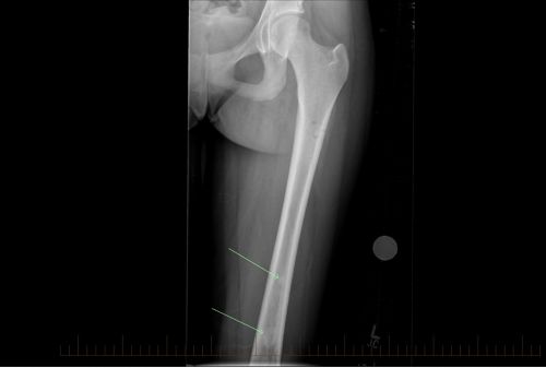 Obraz rentgenowski w projekcji bocznej (uzyskanej z boku ciała) przedstawiający przerzuty skaczące kostniakomięsaka obecne w kości udowej pacjenta.