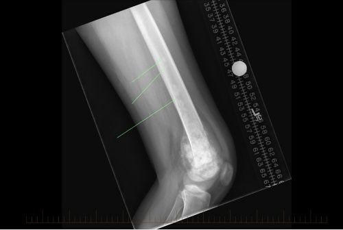 Obraz rentgenowski w projekcji przednio-tylnej (uzyskanej w kierunku od przodu do tyłu ciała) przedstawiający przerzuty skaczące kostniakomięsaka obecne w kości udowej pacjenta.
