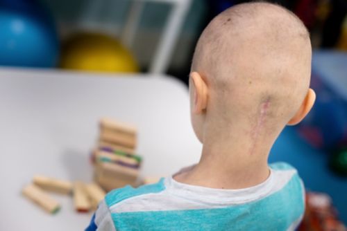 एक युवा कैंसर रोगी जिसके सिर के पीछे एक घाव का निशान है।