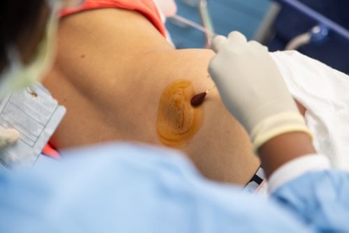 Patients usually lie on their side, and the sample is typically taken from the patient’s hipbone.