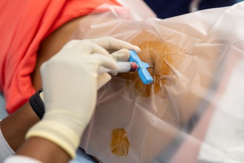 A small sample of bone marrow is removed using a thin, hollow needle attached to a syringe.