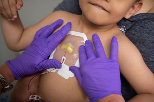 As infeções de cateter central em crianças com câncer podem ocorrer quando germes entram no sangue do paciente através do cateter central.