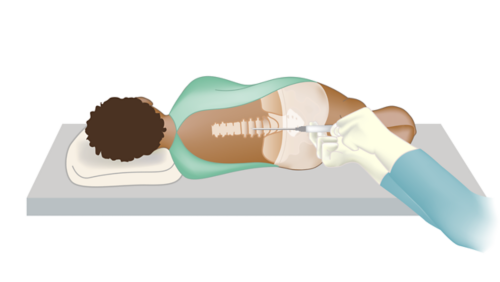 Пациент в положении лежа на боку с иглой, введенной в позвоночник для проведения люмбальной пункции