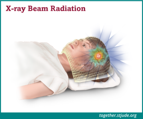 Radiation therapy uses beams of radiation, X-rays or protons, to shrink tumors and kill cancer cells. Radiation works by damaging the DNA inside cancer cells.