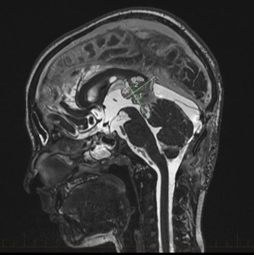 MRI scan with markings showing pineoblastoma. About half of pineal gland tumors are pineoblastomas.