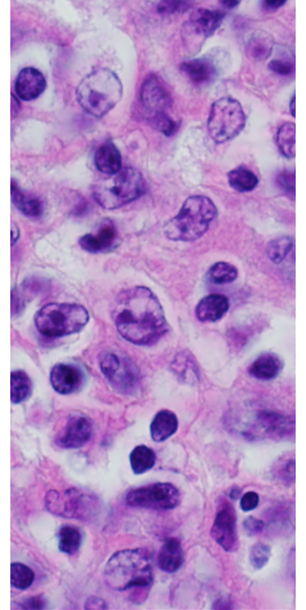 Primary mediastinal large B-cell lymphoma cells as seen through a microscope.