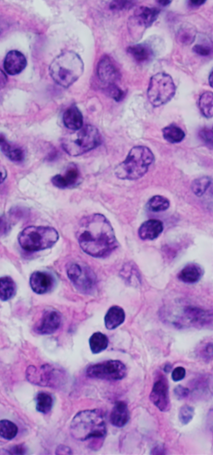 Primary mediastinal large B-cell lymphoma cells as seen through a microscope.