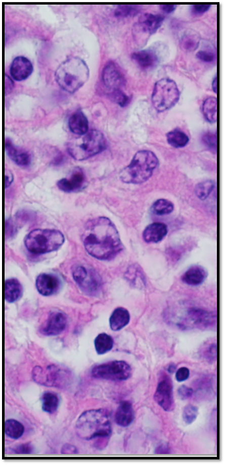 Primary mediastinal large B-cell lymphoma
