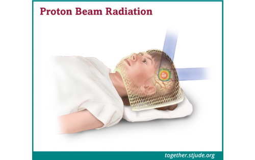 Illustration for proton beam radiation
