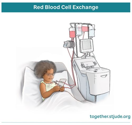 Medical illustration of female child in hospital bed receiving red blood cell exchange through IV