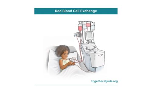 Medical illustration of child in hospital bed undergoing red blood cell exchange