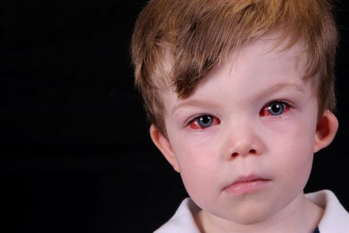 Boy with red eyes after undergoing strabismus surgery