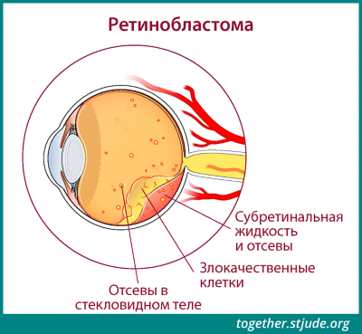 Ретинобластома что это такое простыми словами