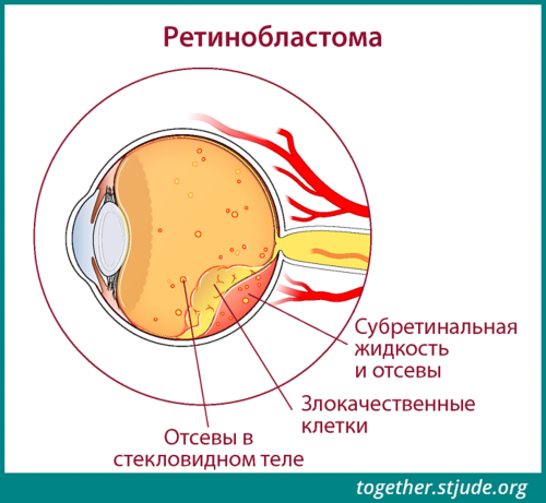 На этом рисунке показаны признаки ретинобластомы в анатомических структурах глаза: отсевы в стекловидное тело, раковые клетки, субретинальная жидкость и ее обсеменение.