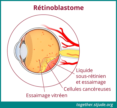 Dans cette illustration sont représentés les signes de la maladie. Le rétinoblastome est identifié dans l'anatomie de l'œil : essaimage vitréen, cellules cancéreuses, liquide sous-rétinien et essaimage.
