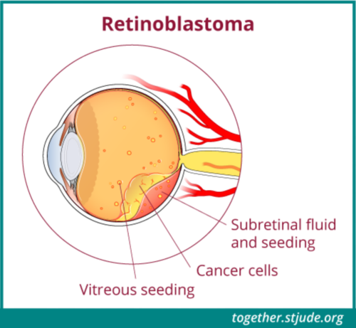 该图示显示眼部解剖结构中标记有视网膜母细胞瘤的疾病体征：玻璃体种植、癌细胞、视网膜下体液和种植。