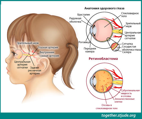 Ретинобластома - Педиатрия - Справочник MSD Профессиональная версия