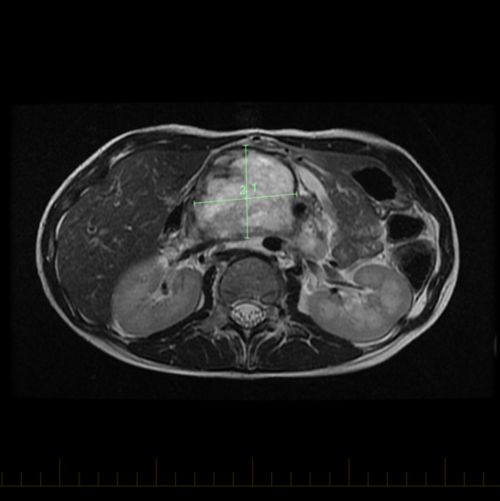 အရိုးဆက်ကြွက်သား ဆာကိုမာကင်ဆာ ကလေးလူနာ၏ဝမ်းဗိုက် MRI၊ ကန့်လန့်ဖြတ်အပိုင်းမြင်ကွင်း (သို့) ဝင်ရိုးမြင်ကွင်း။