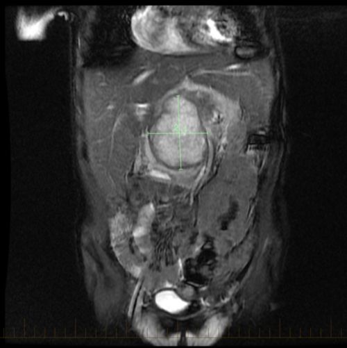小儿横纹肌肉瘤患者腹部的 MRI，肿瘤被标出