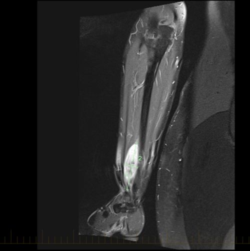 MRI of pediatric rhabdomyosarcoma patient's forearm with tumor marked