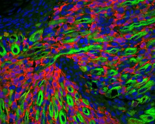 Dans cette image, obtenue à l'aide d'un microscope, d'un rhabdomyosarcome in situ, les cellules immatures constituant la tumeur apparaissent en rouge et entourent les vaisseaux sanguins formant des tumeurs entre les fibres musculaires, représentées en vert.