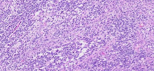 image of rms with anaplasia maginified 20x