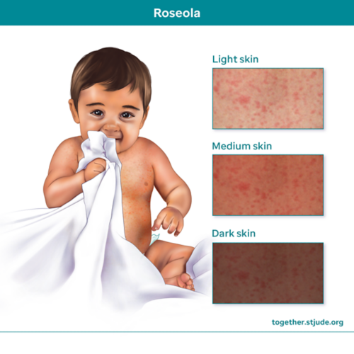 Roseola rash on different skin tones