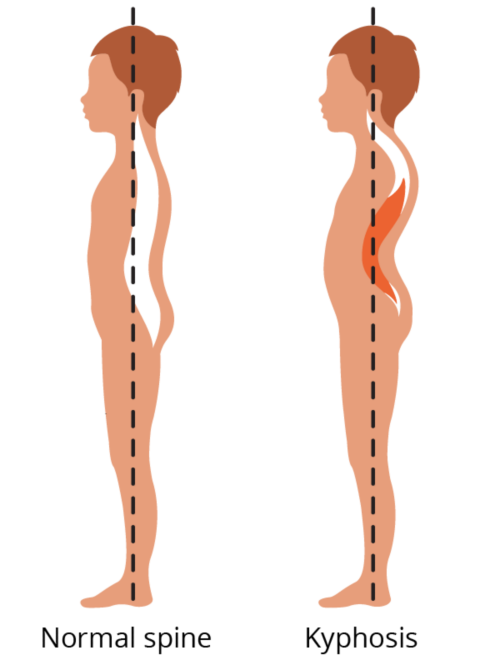 La imagen muestra una columna vertebral normal en comparación con una columna vertebral con cifosis