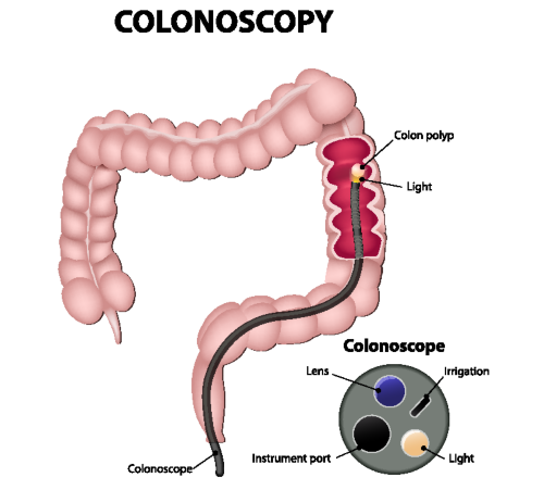 The colonoscopy is the the gold standard in testing for colorectal cancer.