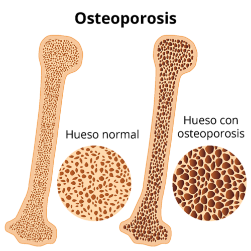 Un gráfico de dos huesos que muestran la masa ósea. A la izquierda se ve una densidad ósea normal. A la derecha se observa una densidad ósea más porosa, un indicador de osteoporosis.