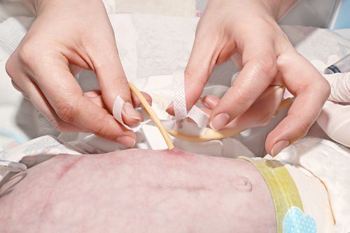 Una mujer coloca una gasa sobre el sitio de la sonda de gastrostomía en un niño.