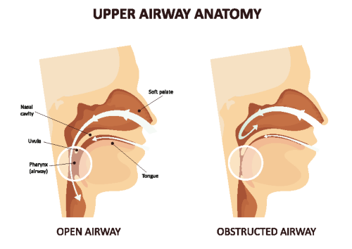 Sleep apnea is caused by narrowing of the upper airway or throat during sleep. Closing of the airway is more common during sleep because the muscles of the throat and tongue relax.