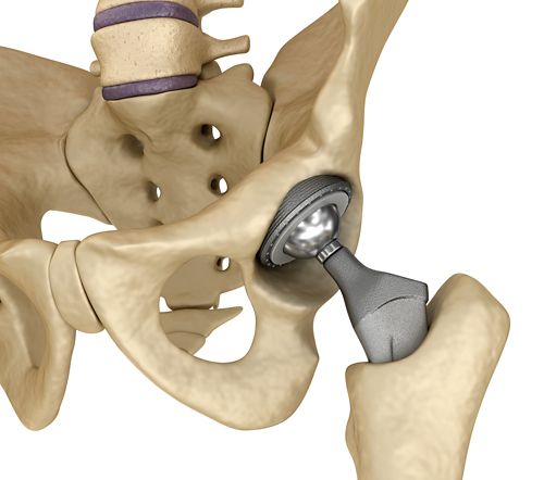 Alguns pacientes podem precisar de cirurgia, como substituição da articulação, para tratar a NAV.